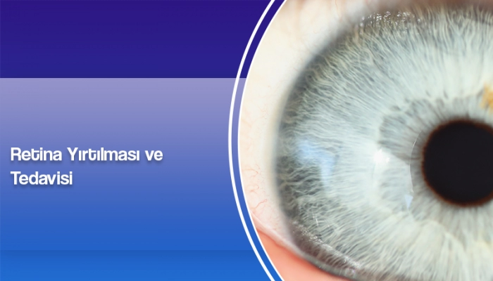 retina-yirtigi-nasil-tedavi-edilir-ates-yanyali