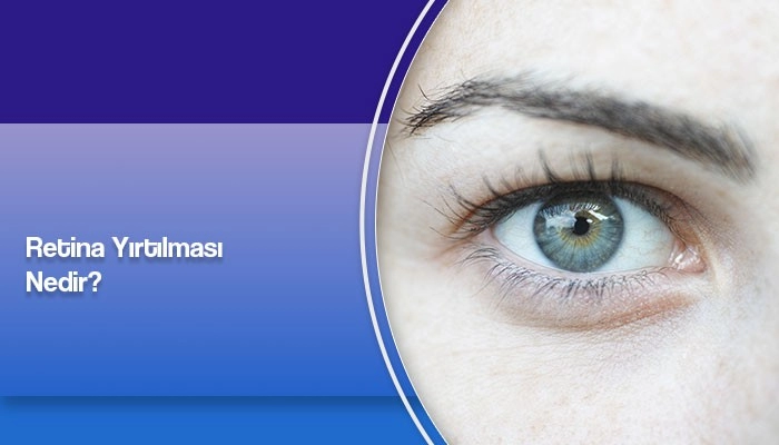 retina-yirtilmasi-nedir-prof-dr-ates-yanyali