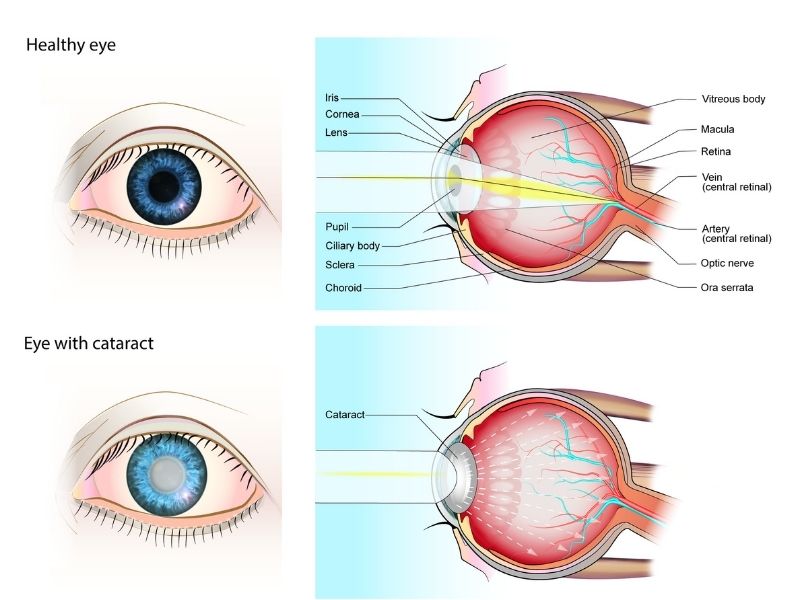 sari-nokta-ve-katarakt-ayni-anda-gorulebilir-mi